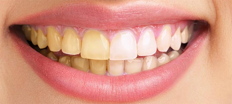 dientes amarillos y blancos