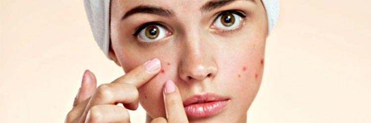 consejos para prevenir el acné