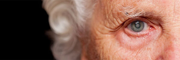 Persona mayor con cataratas en los ojos